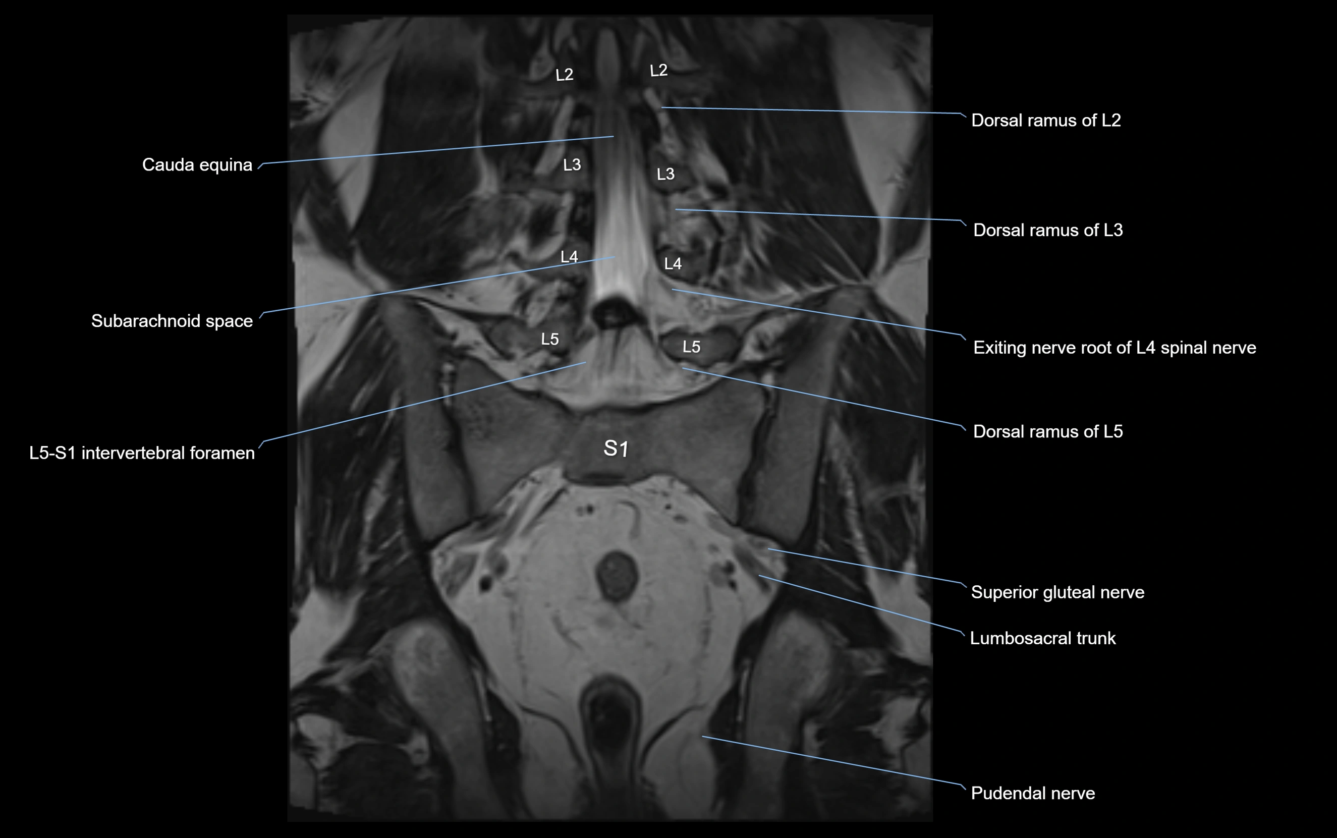MR lumbosacral plexus cross sectional anatomy 3T  radiology  image-img-09001-00043.webp